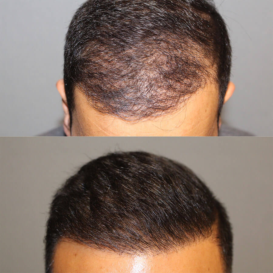 Hair Restoration Before & After | San Diego | Roseville | Capitis Medical &  Aesthetics