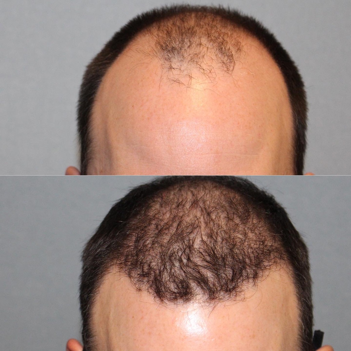 Hair Restoration (Transplantation) Before and After | Capitis Medical &  Aesthetics
