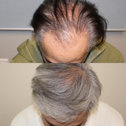 Hair Transplant Before and After 011