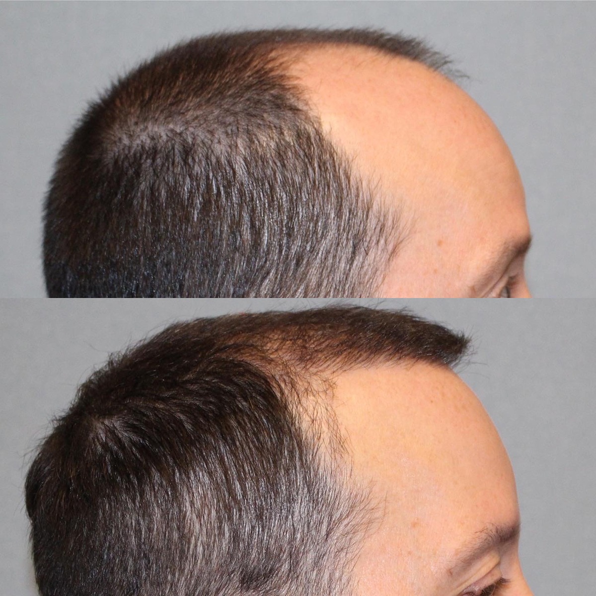 Hair Restoration (Transplantation) Before and After | Capitis Medical &  Aesthetics