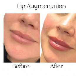 Lip Injections and Fillers Before and After