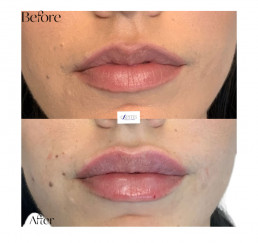 Lip Injections and Fillers Before and After