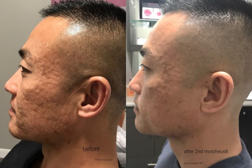 Morpheus8 Before and After - Capitis Medical & Aesthetics