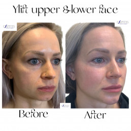 YLift Before and After