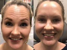 Botox Before and After