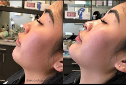 Dermal Fillers Before and After