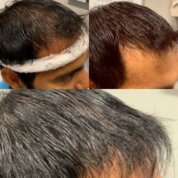 Hair Regeneration Before and After