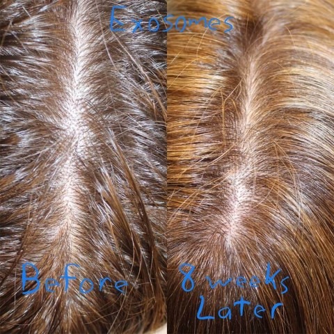 Hair Regeneration Before and After