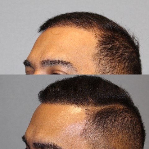 Hair Transplant Before and After