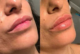 Lip Fillers Before and After