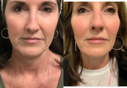 Sculptra Before & After